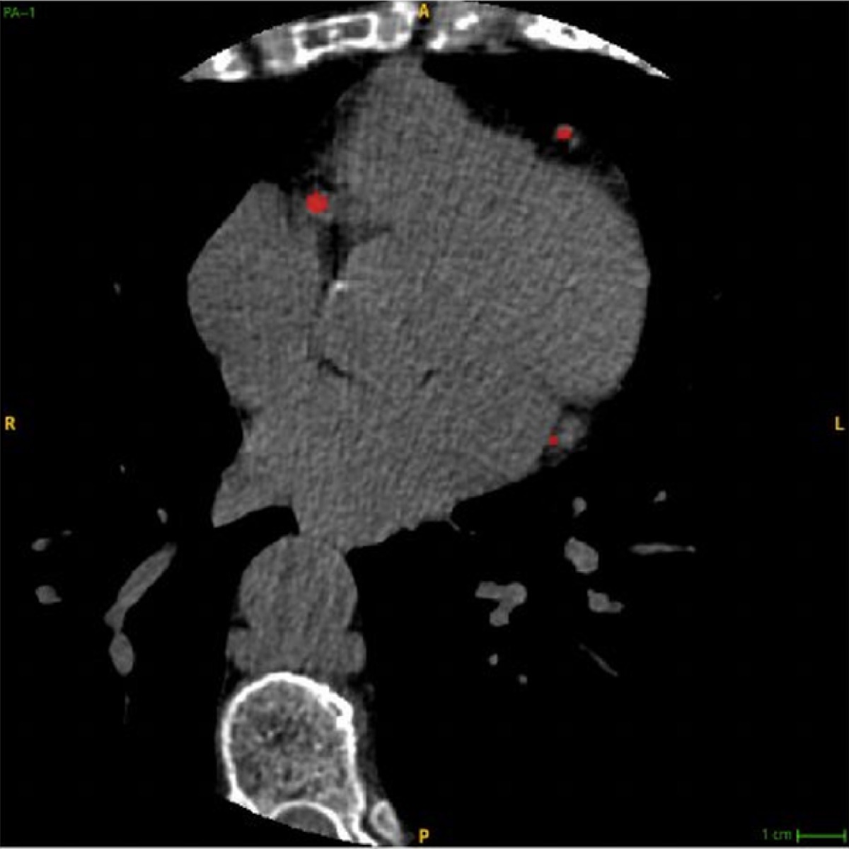 Routine non-contrast CAC scan.