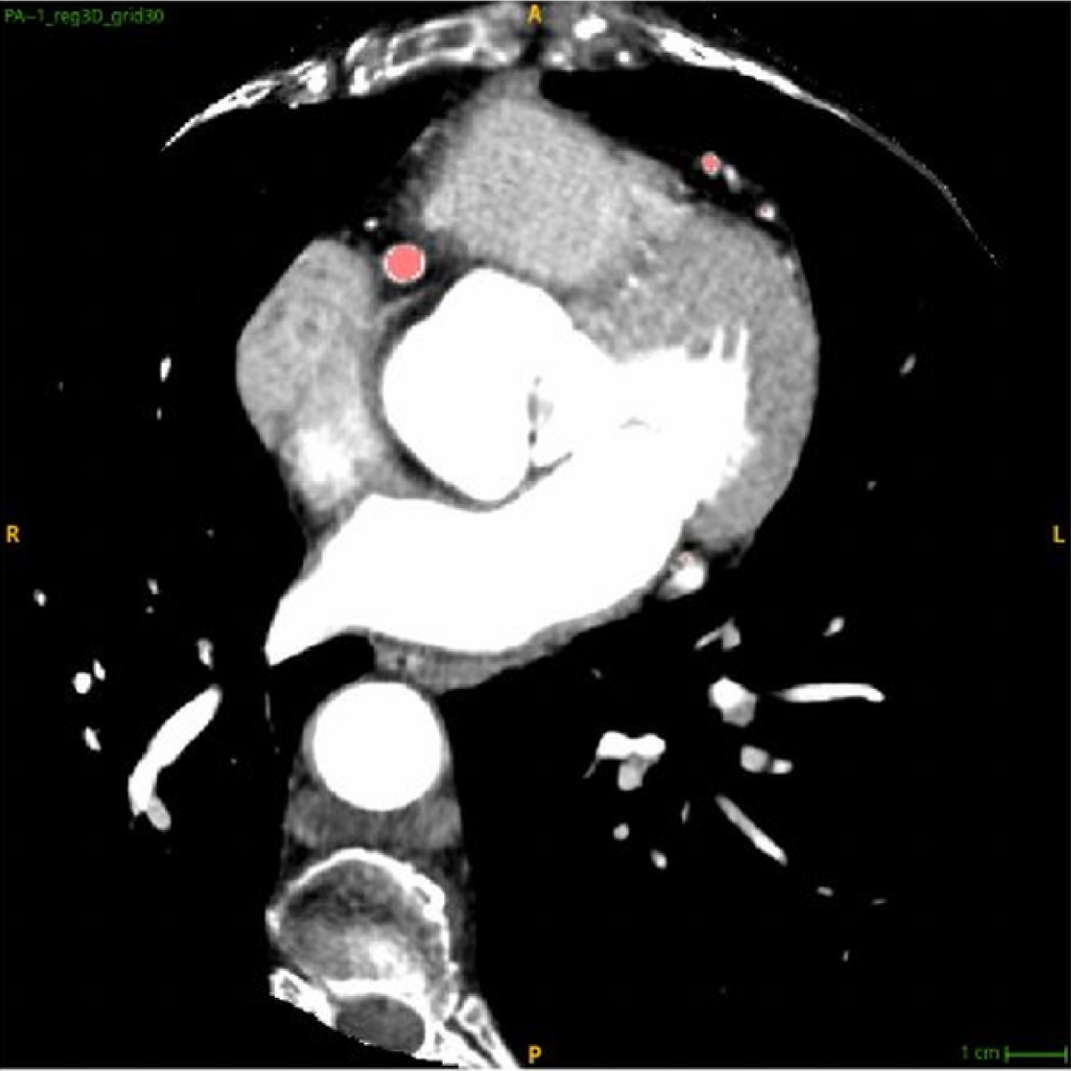 Real contrast-enhanced CCTA of the same patient, for reference.