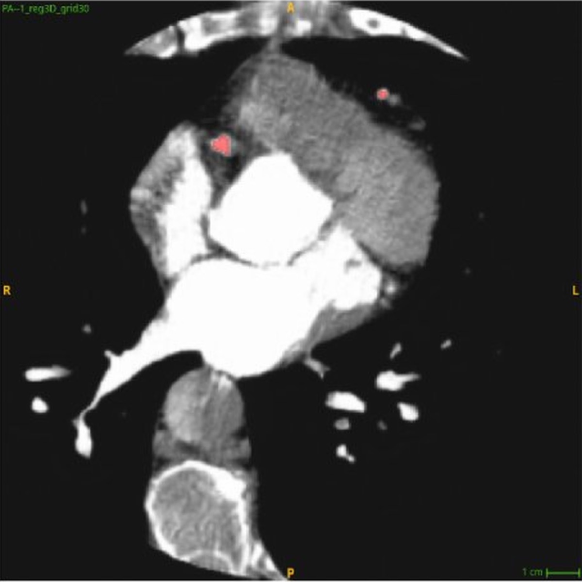Lucentia Virtual CCTA generated from the same CAC scan, showing the contrast-enhanced coronary anatomy.